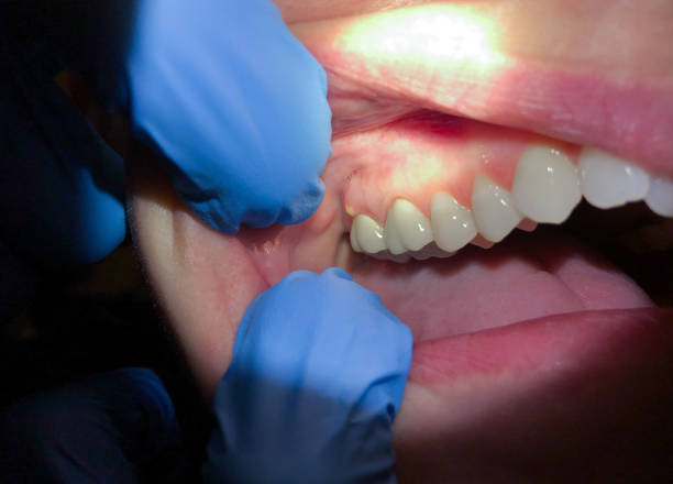 Best Emergency Root Canal Treatment in Baldn, WI